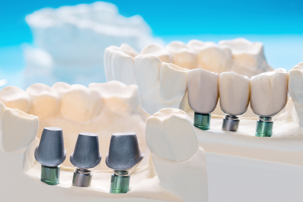 How To Find An Experienced Implant Dentist